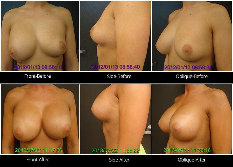 Breast Implant Revision Before & After 2 Full