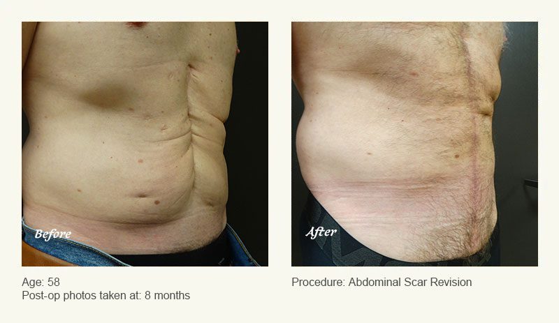 Reconstructive Surgery in Plano, TX - Patient 2
