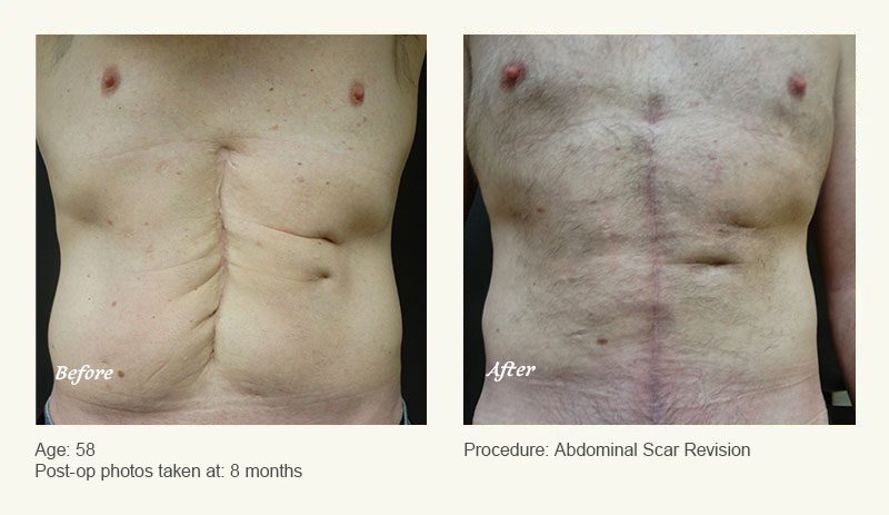 Reconstructive Surgery in Plano, TX - Patient 1