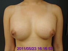 Breast implant results after