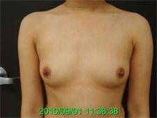 Breast implant results before