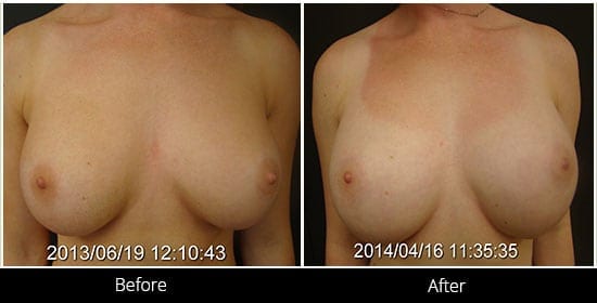 Breast Implant Revision Before & After 3 Front