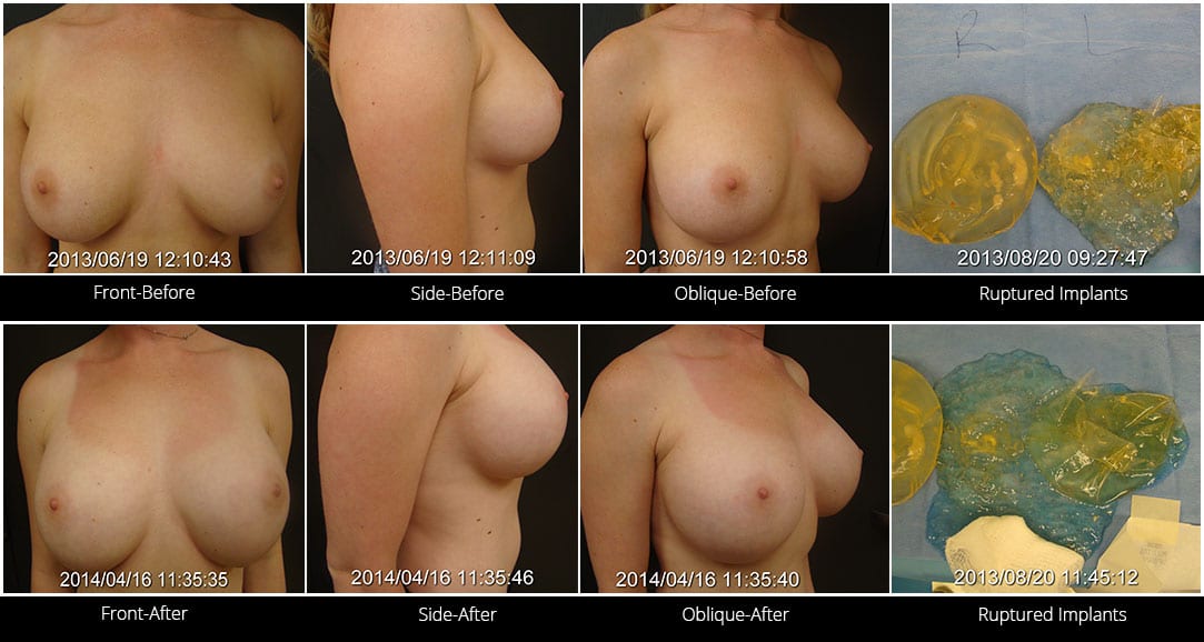 Breast Implant Revision Before & After 3 Full