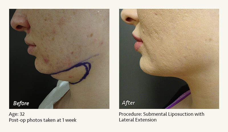 Chin Liposuction in Plano, TX - Patient 42