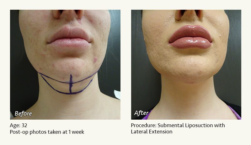 Chin Liposuction in Plano, TX - Patient 41