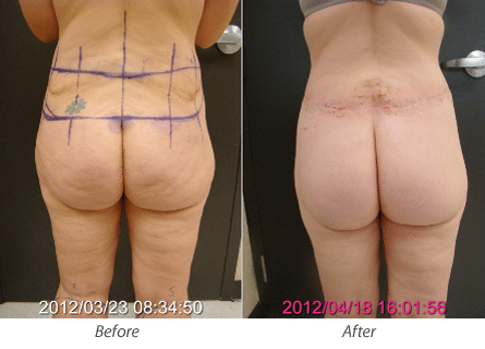 Thigh Lift Before & After