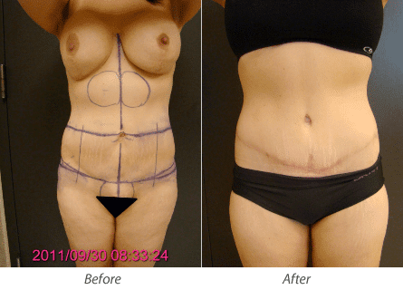 Post Dramatic Weight Loss Plastic Surgery Pocedures in Plano & Dallas, TX