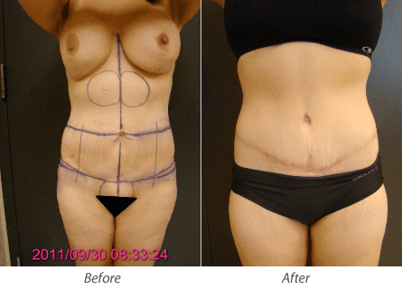 Tummy-Tuck (Abdominoplasty) and Lower Body Lift