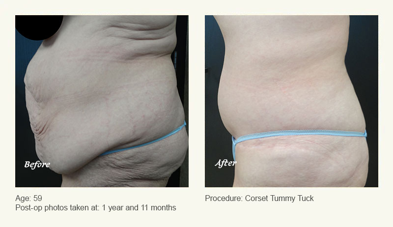 Tummy Tuck in Plano, TX - Patient 2
