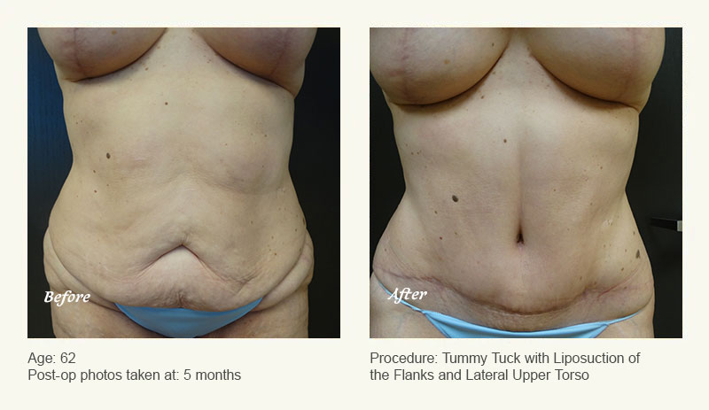 Tummy Tuck in Plano, TX - Patient 1