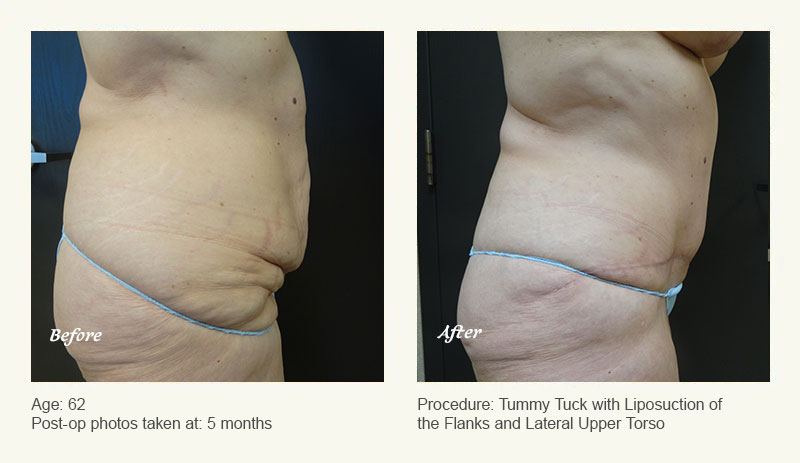 Tummy Tuck in Plano, TX - Patient 2