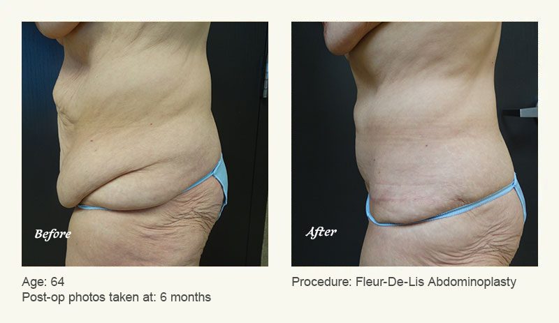 Tummy Tuck in Plano, TX - Patient 4
