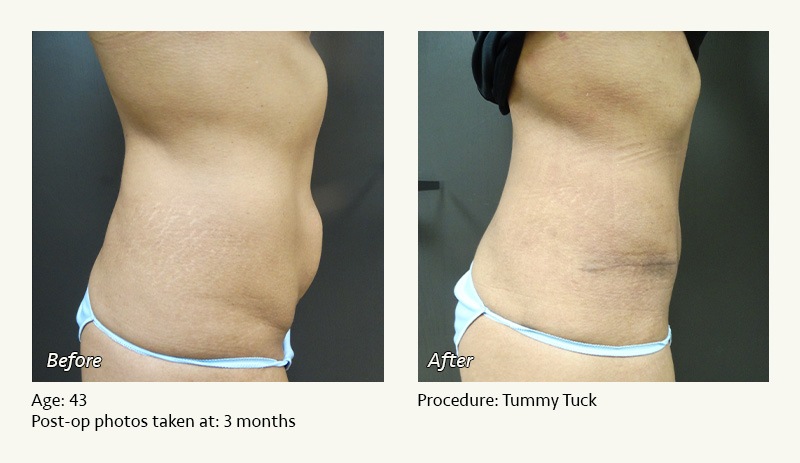 Tummy Tuck in Plano, TX - Patient 2