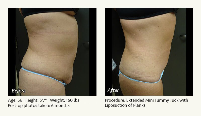 Tummy Tuck in Plano, TX - Patient 51
