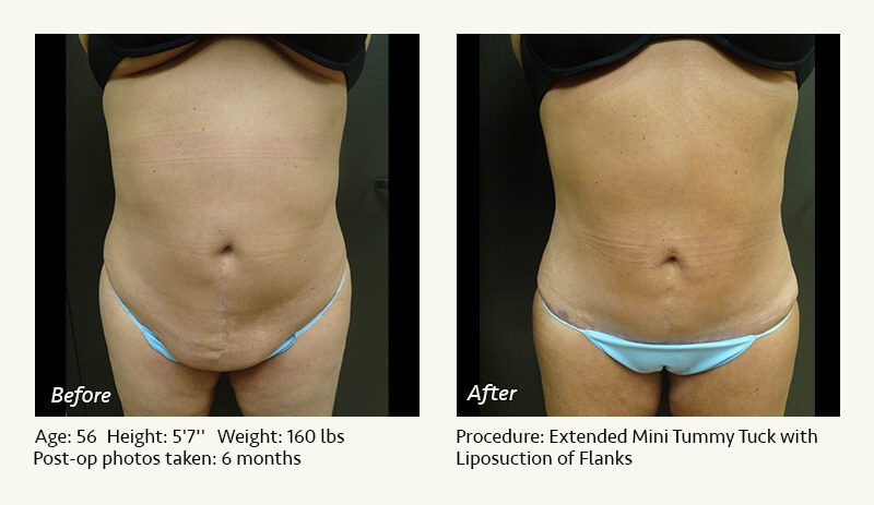 Tummy Tuck in Plano, TX - Patient 50