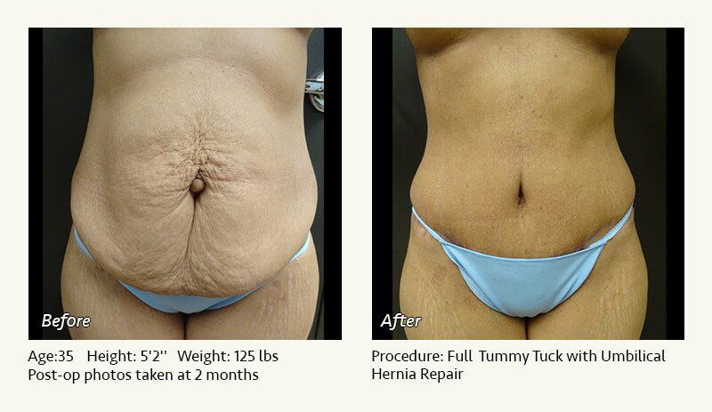 Tummy Tuck in Plano, TX - Patient 48