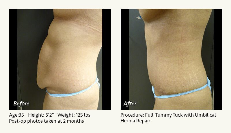Tummy Tuck in Plano, TX - Patient 49
