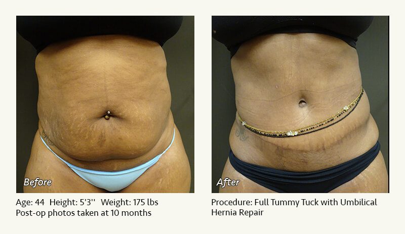 Tummy Tuck in Plano, TX - Patient 44