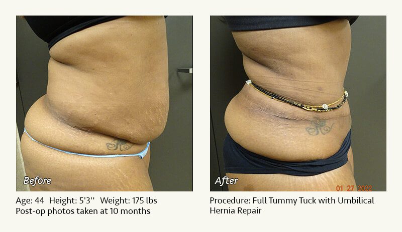 Tummy Tuck in Plano, TX - Patient 45