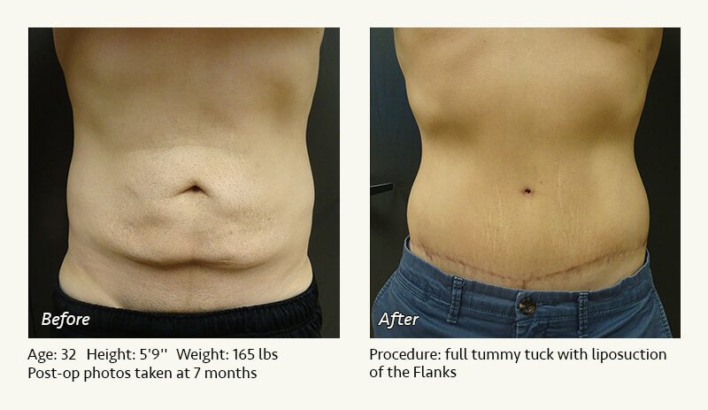 Tummy Tuck in Plano, TX - Patient 41