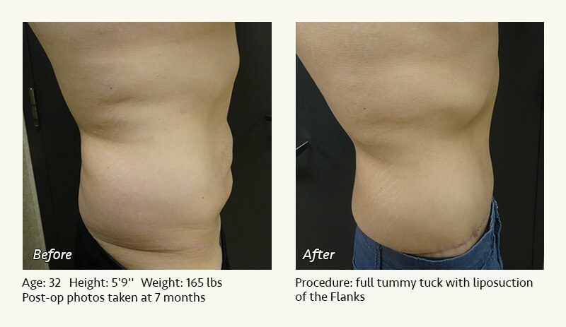 Tummy Tuck in Plano, TX - Patient 42