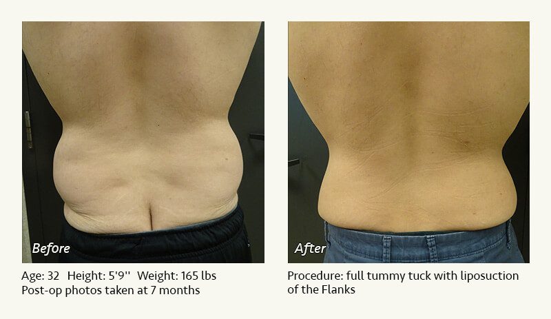 Tummy Tuck in Plano, TX - Patient 43
