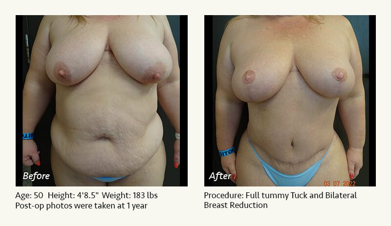 Tummy Tuck in Plano, TX - Patient 31