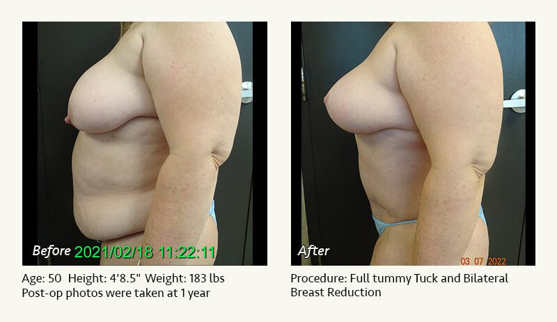 Tummy Tuck in Plano, TX - Patient 32