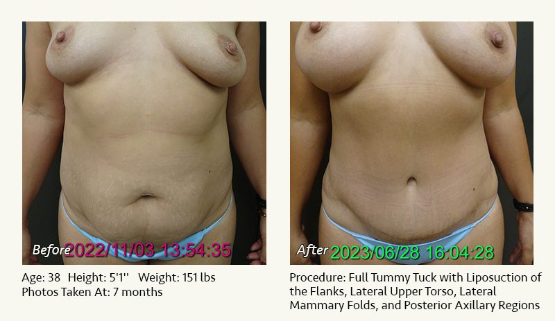 Tummy Tuck in Plano, TX - Patient 29