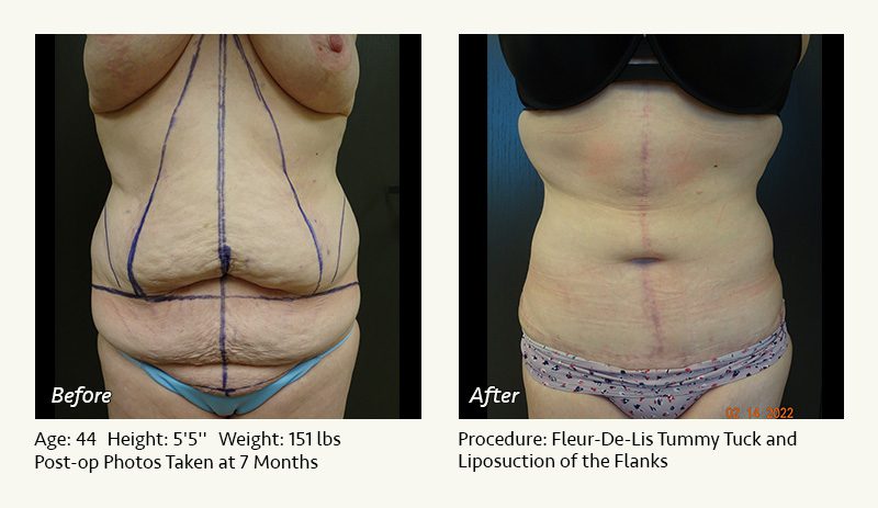 Tummy Tuck in Plano, TX - Patient 39
