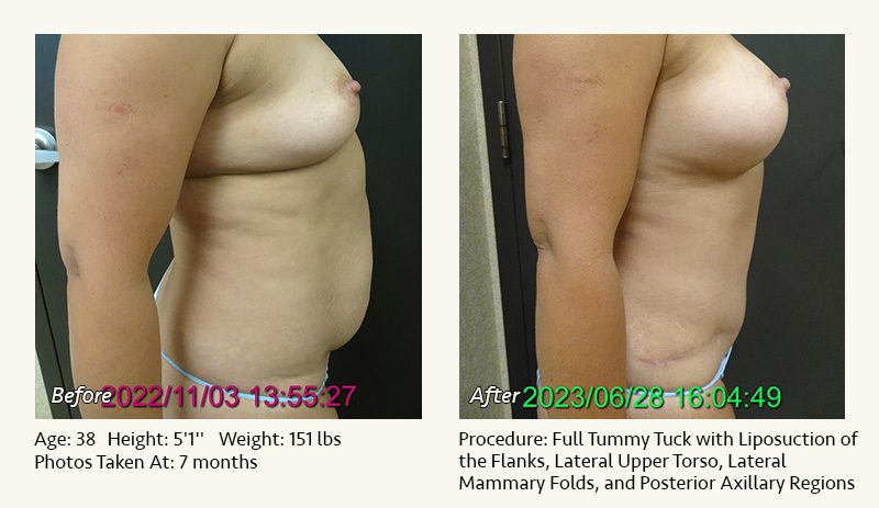 Tummy Tuck in Plano, TX - Patient 30