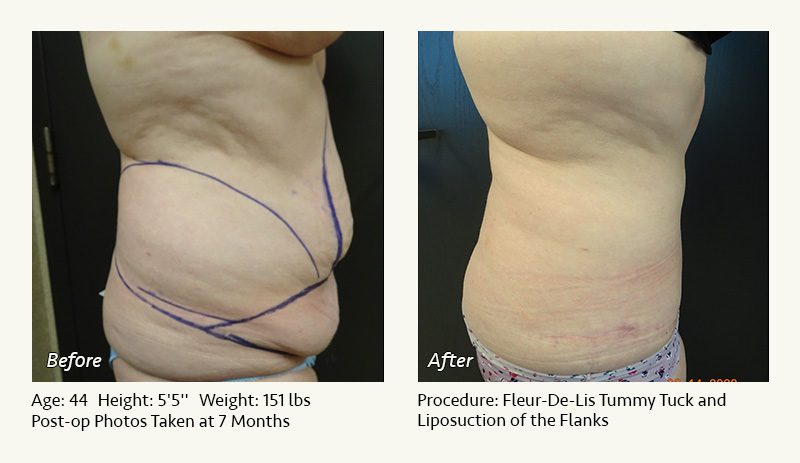 Tummy Tuck in Plano, TX - Patient 40