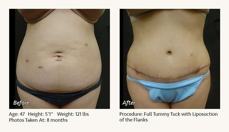 Tummy Tuck in Plano, TX - Patient 27