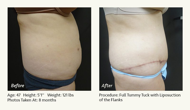 Tummy Tuck in Plano, TX - Patient 28