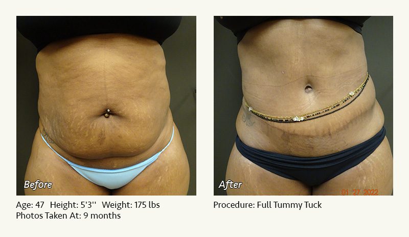 Tummy Tuck in Plano, TX - Patient 25