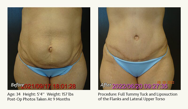 Tummy Tuck in Plano, TX - Patient 35