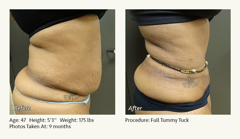 Tummy Tuck in Plano, TX - Patient 26