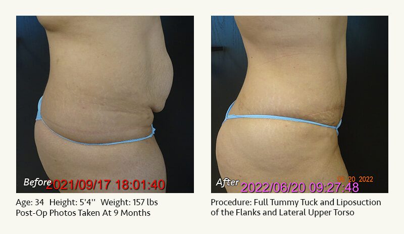 Tummy Tuck in Plano, TX - Patient 36