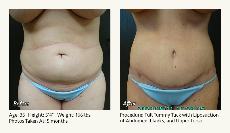 Tummy Tuck in Plano, TX - Patient 23