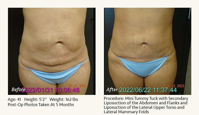 Tummy Tuck in Plano, TX - Patient 33
