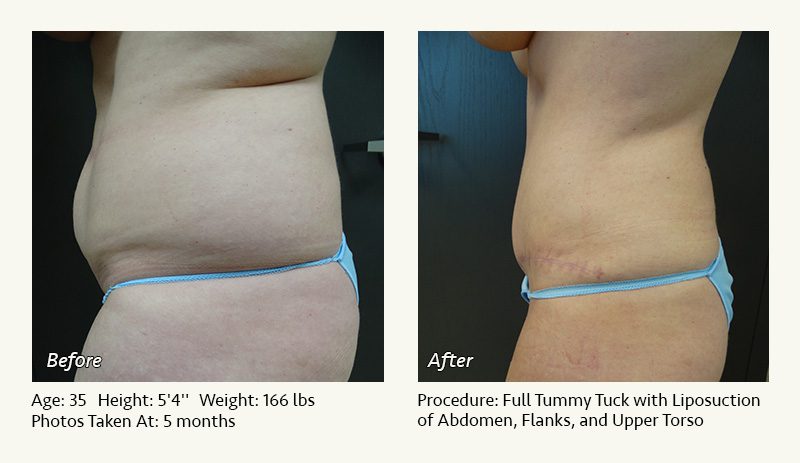 Tummy Tuck in Plano, TX - Patient 24