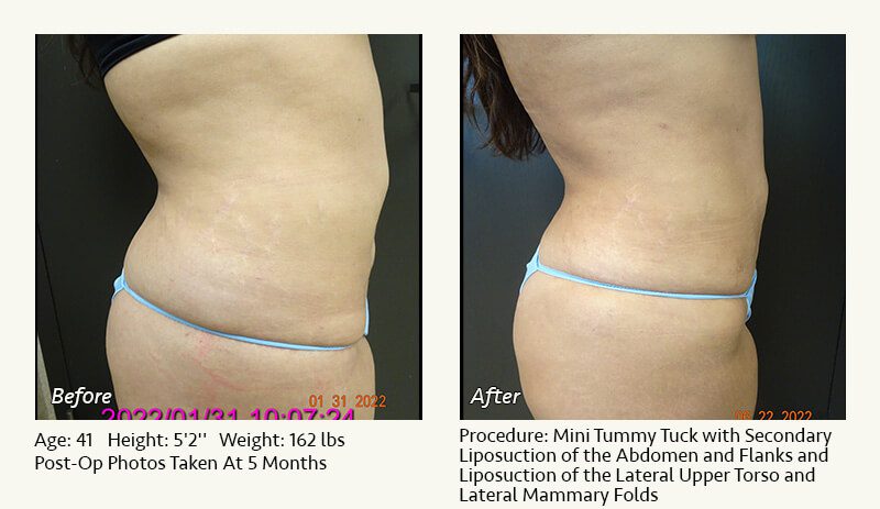 Tummy Tuck in Plano, TX - Patient 34