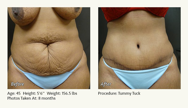 Is a Tummy Tuck Worth It? Everything You Need to Know About This  Body-Contouring Surgery 