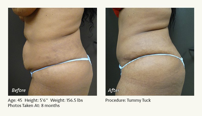 2 weeks post op tummy tuck revision update! As you can see…