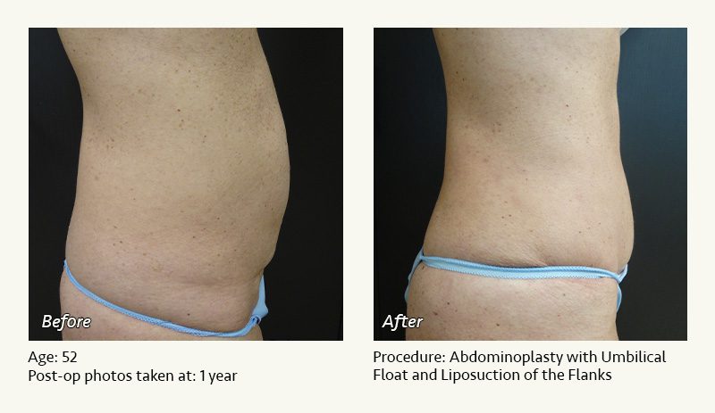 Tummy Tuck in Plano, TX - Patient 18