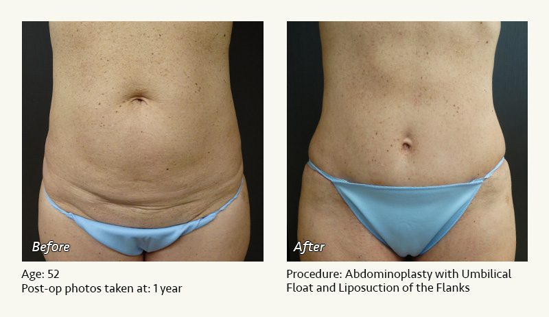Tummy Tuck in Plano, TX - Patient 17