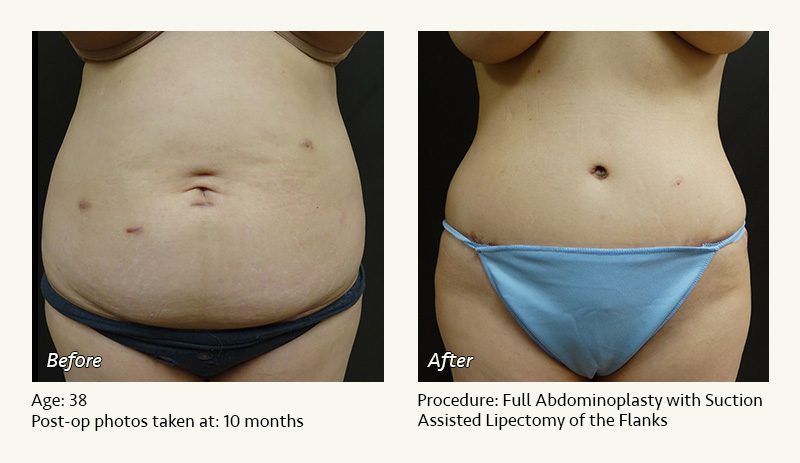 Tummy Tuck in Plano, TX - Patient 15