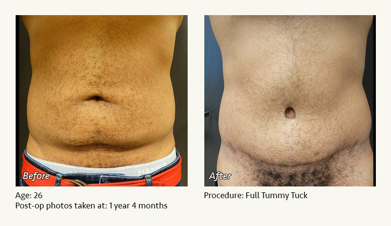 Tummy Tuck in Plano, TX - Patient 13