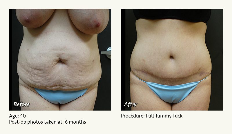 Tummy Tuck in Plano, TX - Patient 7