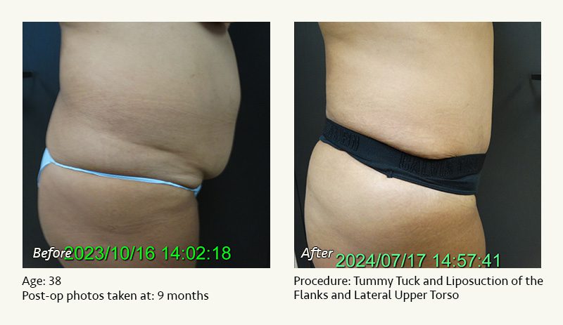 Tummy Tuck in Plano, TX - Patient 12